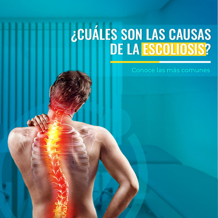 Escoliosis Síntomas Causas Y Tratamiento Fisiofocus 4016